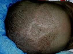 baby throbbing soft spot on head
