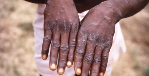 Monkey Pox Outbreak In Nigeria
