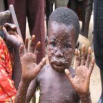 Monkey Pox Outbreak In NIgeria