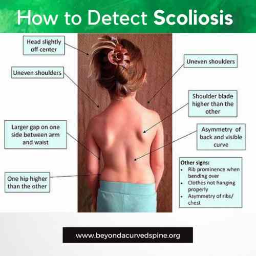 what is scoliosis